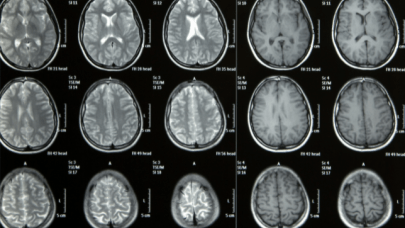 Brain MRI