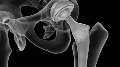 X-ray of hip replacement